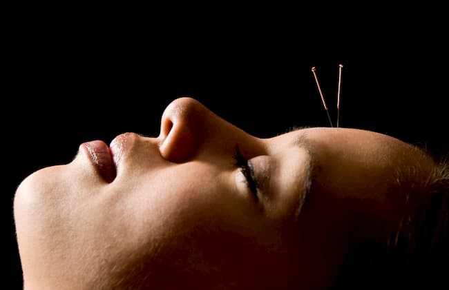 Can You Use Acupuncture To Cure Hangover?
